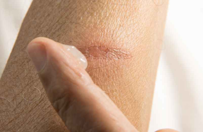 Comment appliquer la crème cicatrisante sur la plaie ? Blune Comment appliquer la crème cicatrisante sur la plaie ? Blune