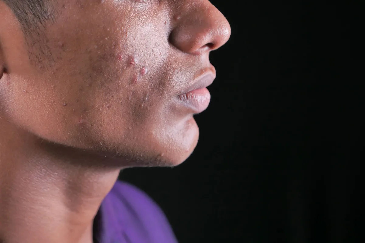 Différents types de lésions d'acné : comédons, papules et pustules sur la peau