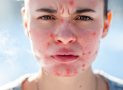 Allergie au froid : causes, symptômes et traitements