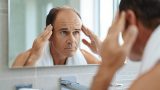 Comment prévenir et traiter la calvitie chez l&rsquo;homme ?