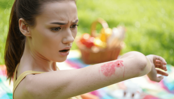 Comment reconnaître et réagir à une allergie aux piqûres d&rsquo;insectes?