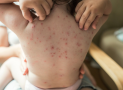 Peut-on emmener son enfant à la piscine quand il a la varicelle ?