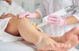 Épilation au laser : est-ce une méthode sûre et définitive ?