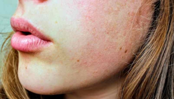 Lupus chez la femme : symptômes typiques et traitement à connaître